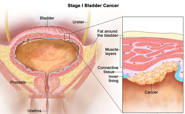 Bladder Surgery – Types of Bladder Surgery