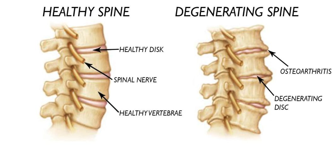 Spinal Degeneration Causes And Symptoms EsHealthTips spinal-degeneration-causes-and-symptoms-eshealthtips