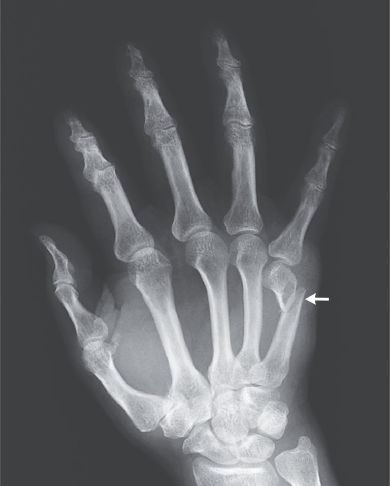 Treating Metacarpal Neck Fracture With Ultrasound EsHealthTips