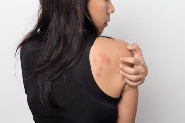 Symptoms Rash Back – What to Do If You Have a Rash