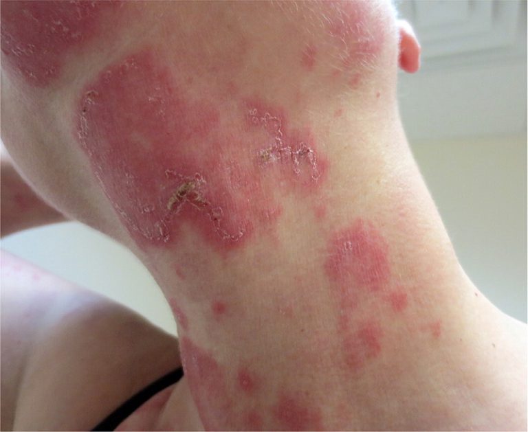 What Causes Circular Lesions On Skin?