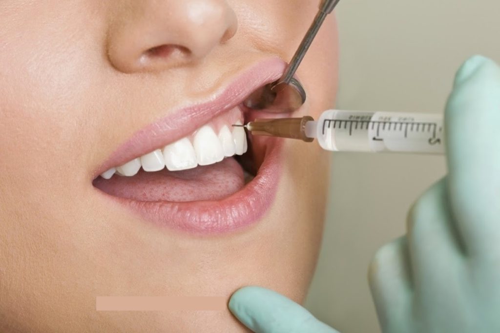 Dental Anesthesia Injection Sites EsHealthTips