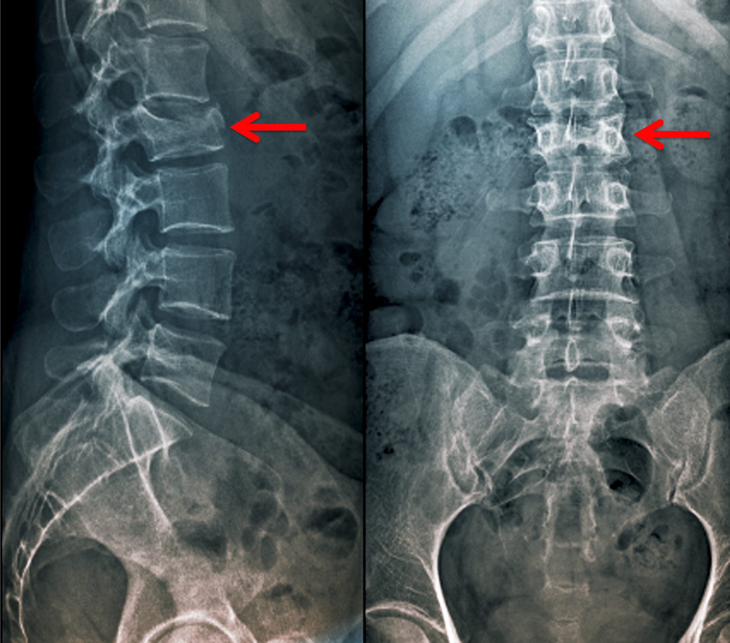 thoracic-burst-fracture-treatment-eshealthtips