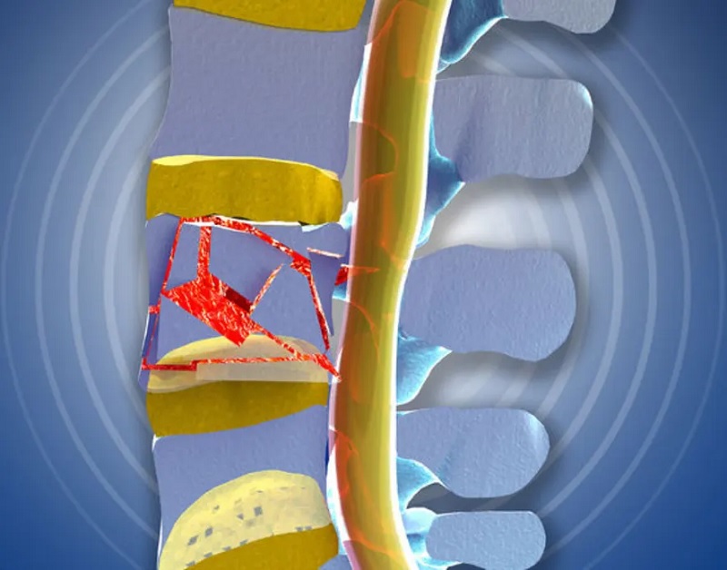 Thoracic Burst Fracture Treatment Eshealthtips