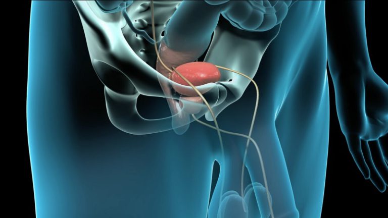 What Is Radical Prostatectomy?