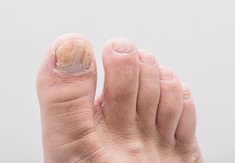 symptoms-of-psoriatic-arthritis-toenails-eshealthtips